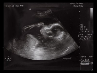 Jak wygląda proces badań prenatalnych? Krok po kroku